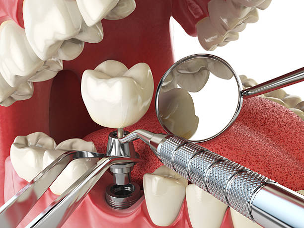Best Emergency Dentist for Knocked-Out Tooth in Port Huron, MI